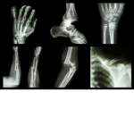 Broken Bones Fans