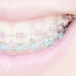 ‘ lovebites