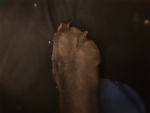 Toe fungus!