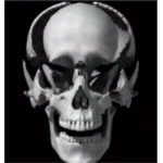 Skull Fracture