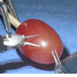 they did surgery on a grape