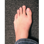 MASSIVETOESS