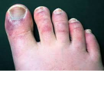Crusty Toe.