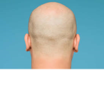 Bald men association