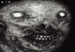 Antichlo