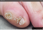 Pinky Toe Gang