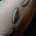 centipedes in my skin