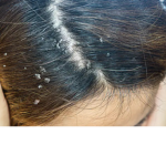 Dandruff fanclub