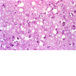 TRANSMISSIBLE SPONGIFORM DISEASES