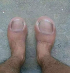 toes fungus