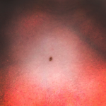 skinmole
