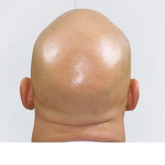Bald Gng