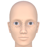 Freckles
