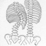 Scoliosis Fighters
