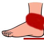RedAnkles