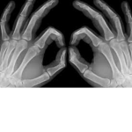 brokenbones