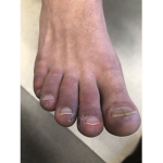TOE EATERS FOR EVERR