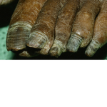 the crusty sausage toenails