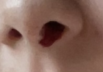 Nose bleed group